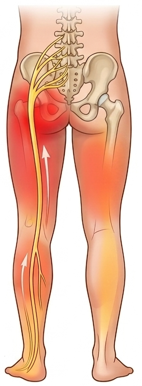 trajet nerf sciatique douleur fesse jambe kinosteo orleans